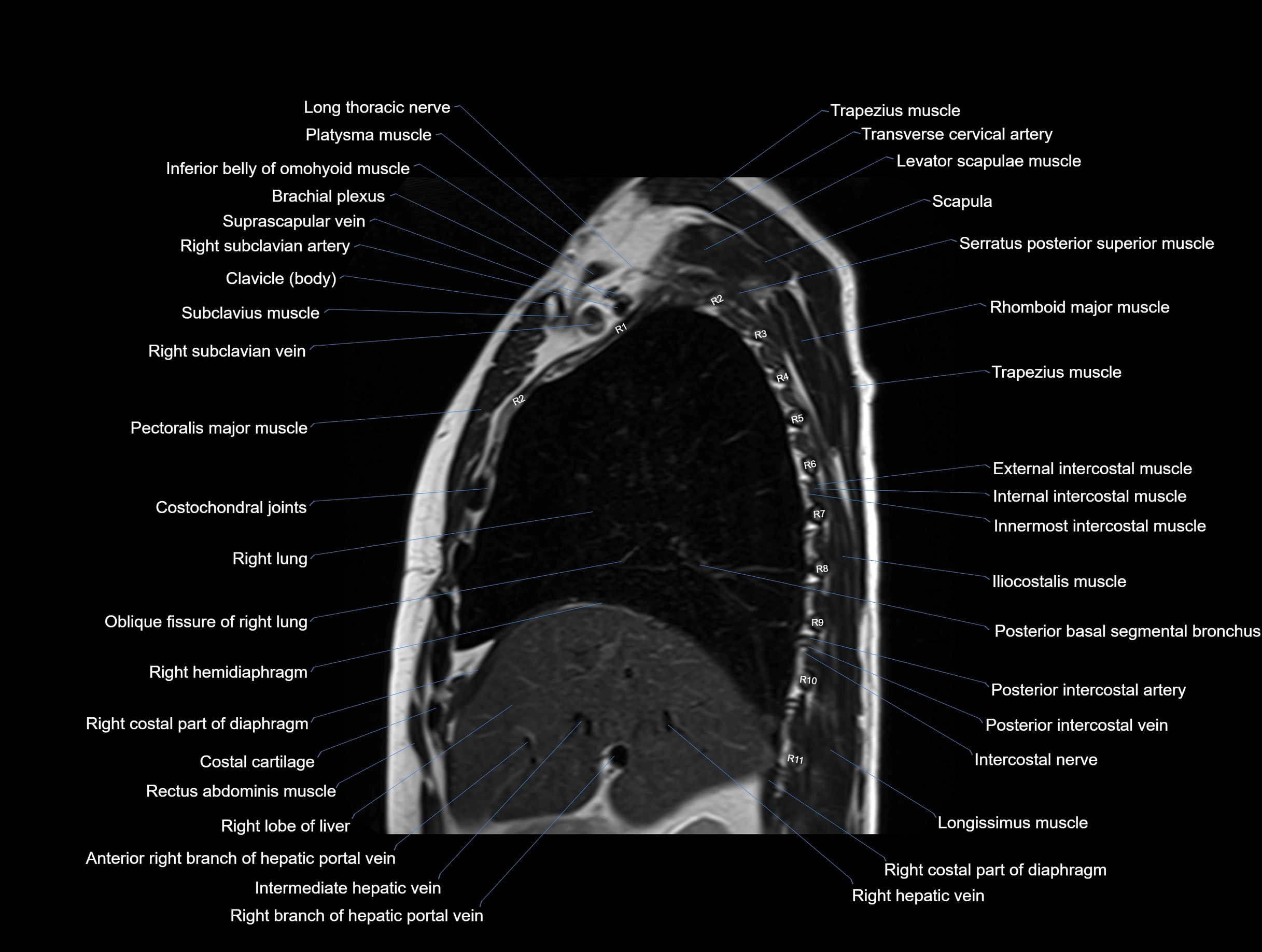 MRI chest (thorax) coronal  cross sectional anatomy 3T radiology  image-img-00001-00013.webp